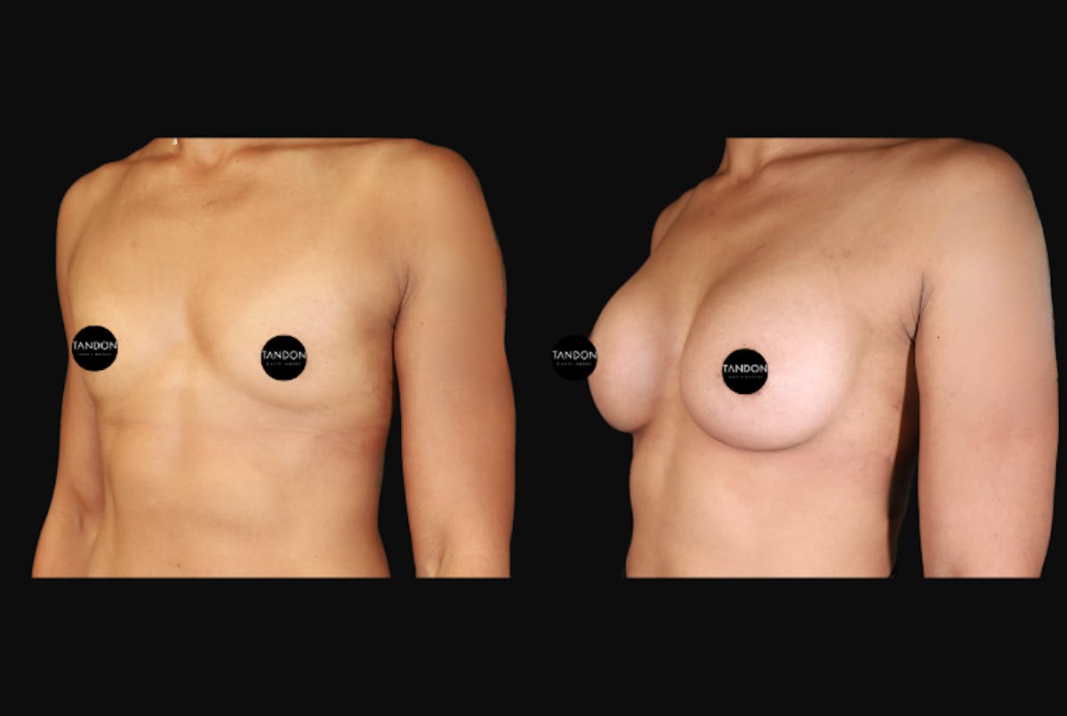 Breast Augmentation Before & After Gallery - Patient 242509 - Image 4