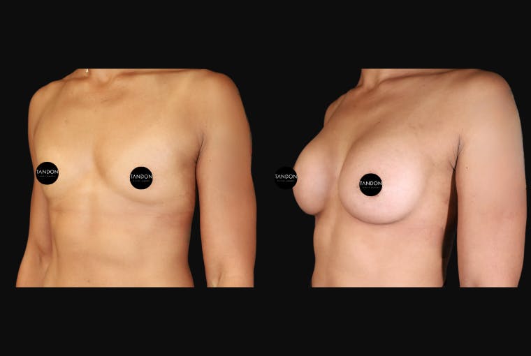 Breast Augmentation Before & After Gallery - Patient 242509 - Image 4