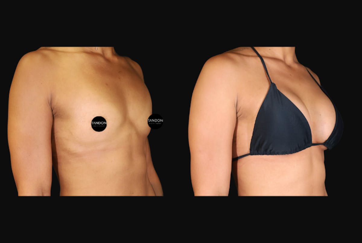 Breast Augmentation Before & After Gallery - Patient 242509 - Image 6
