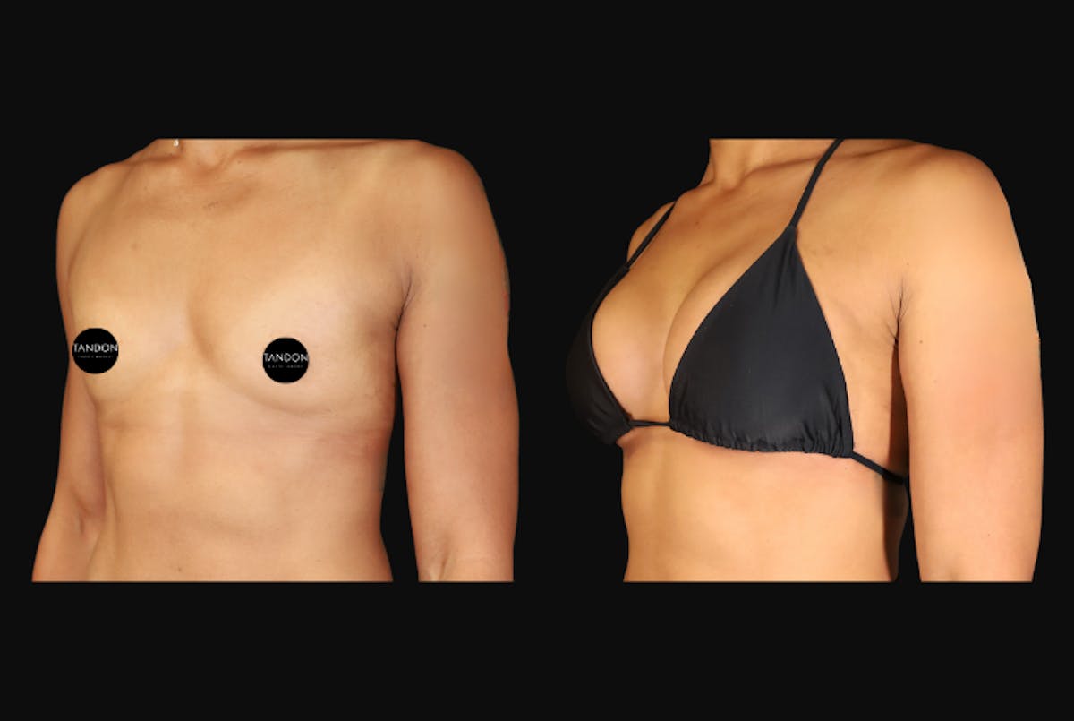 Breast Augmentation Before & After Gallery - Patient 242509 - Image 5