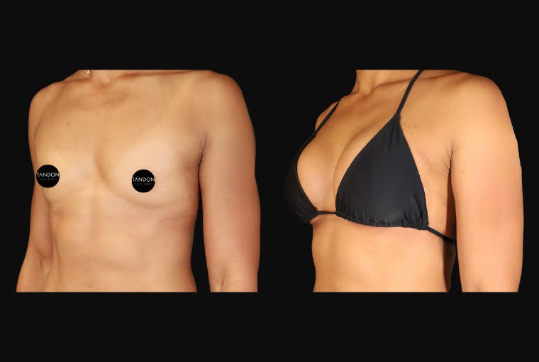Breast Augmentation Before & After Gallery - Patient 242509 - Image 5