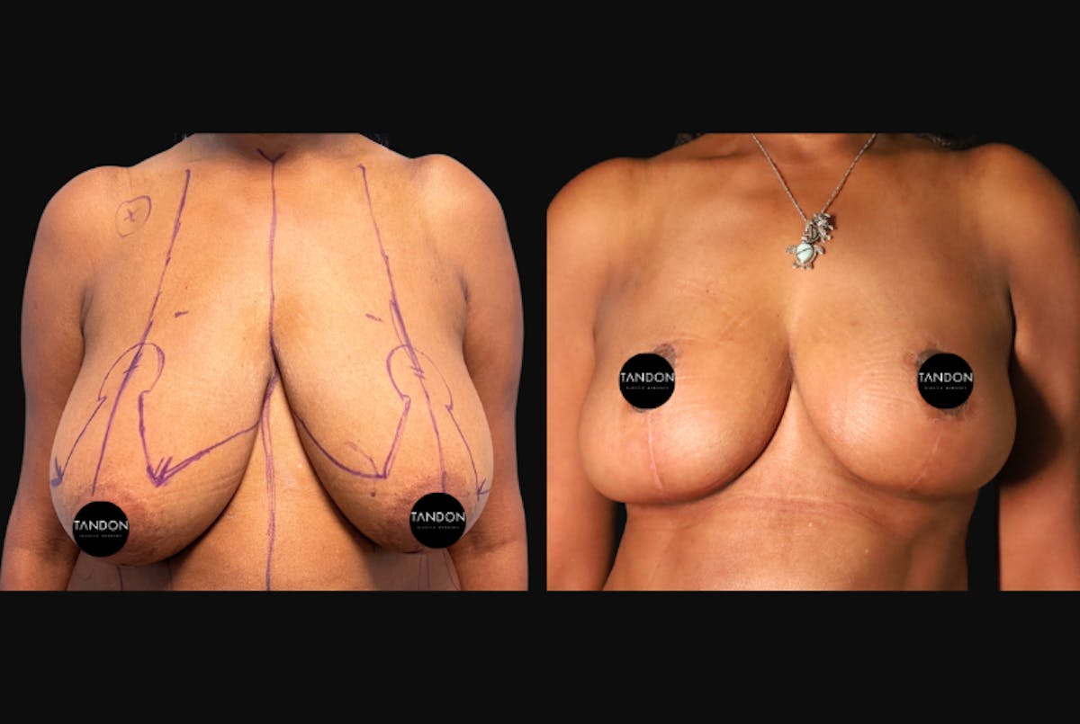 Breast Augmentation Before & After Gallery - Patient 319707 - Image 1
