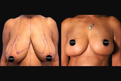 Breast Lift Before & After Gallery - Patient 338235 - Image 1