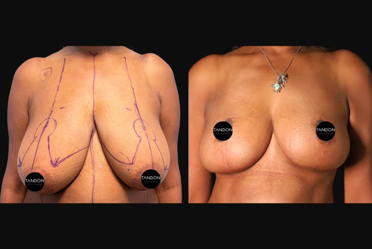 Breast Augmentation Before & After Gallery - Patient 319707 - Image 1