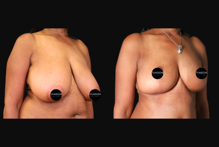 Breast Augmentation Before & After Gallery - Patient 319707 - Image 2