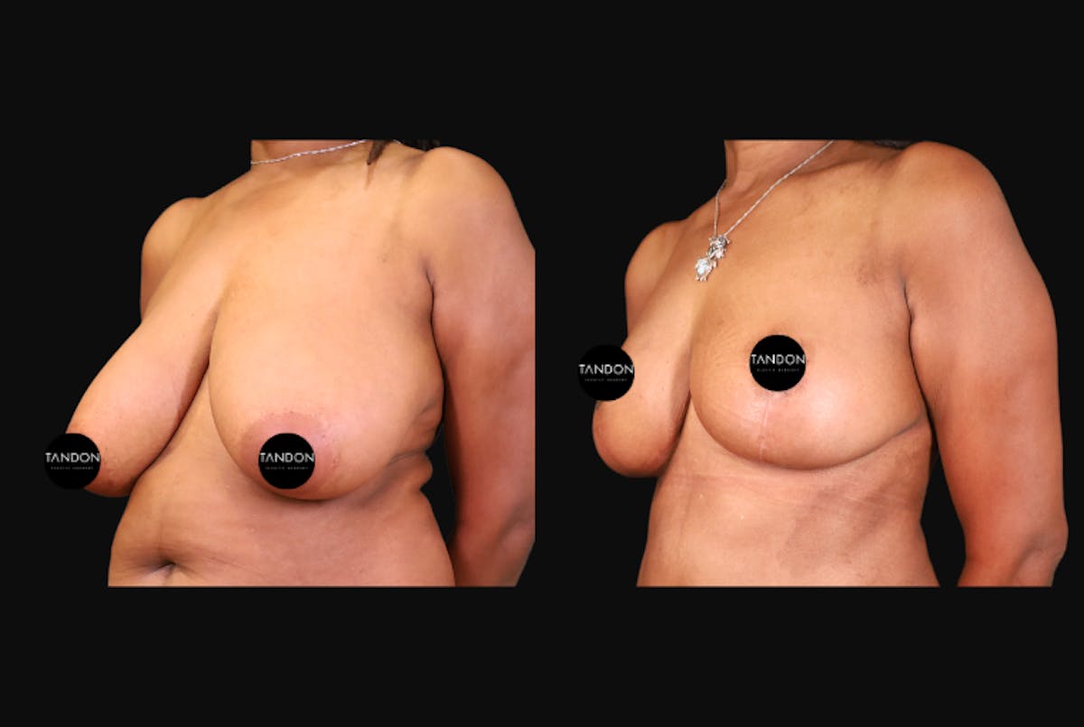 Breast Augmentation Before & After Gallery - Patient 319707 - Image 5