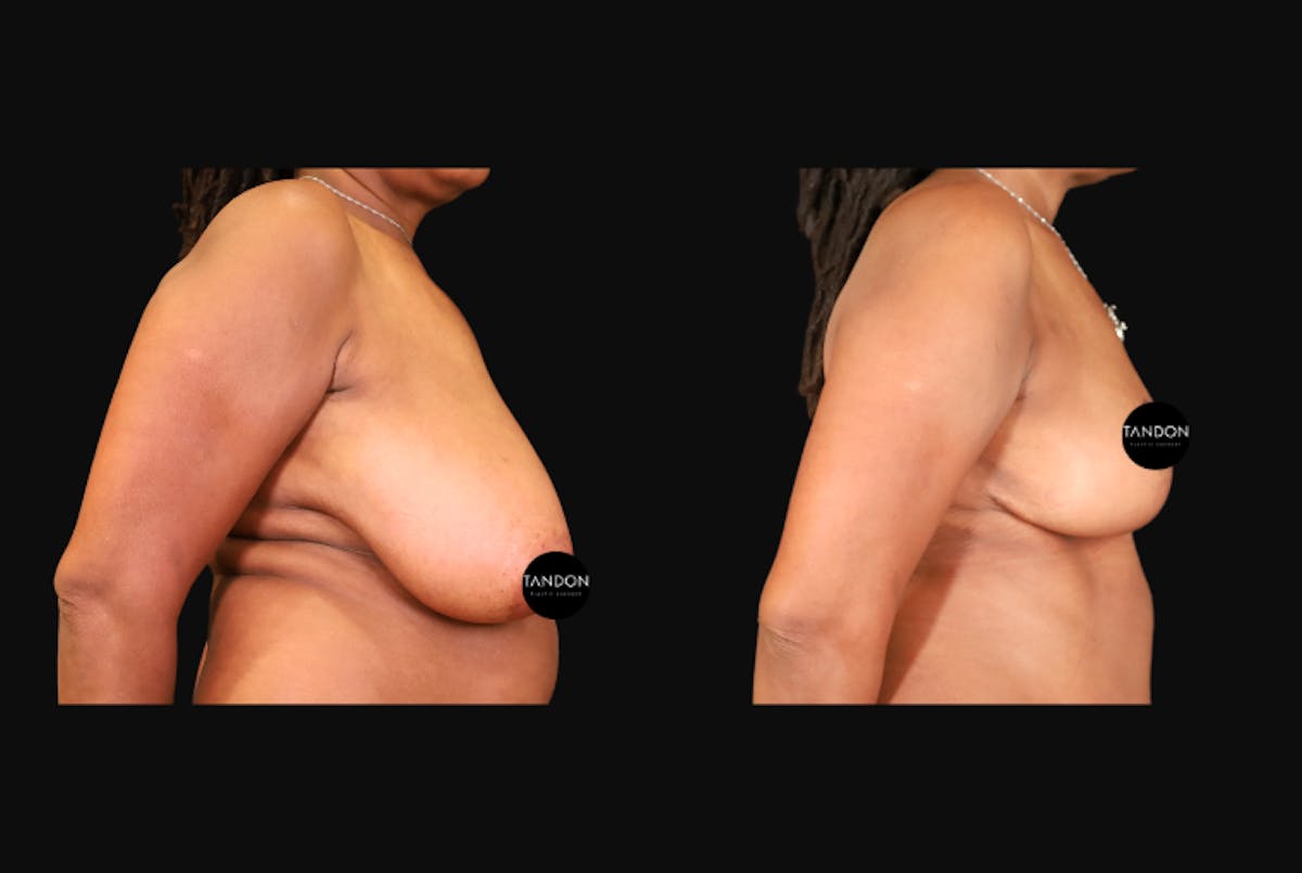 Breast Augmentation Before & After Gallery - Patient 319707 - Image 3
