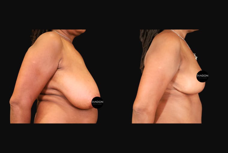 Breast Augmentation Before & After Gallery - Patient 319707 - Image 3
