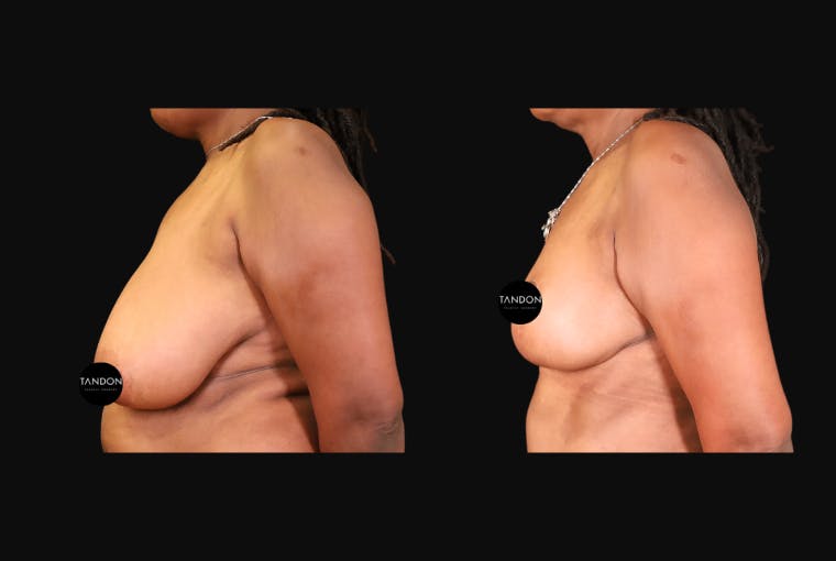 Breast Augmentation Before & After Gallery - Patient 319707 - Image 4