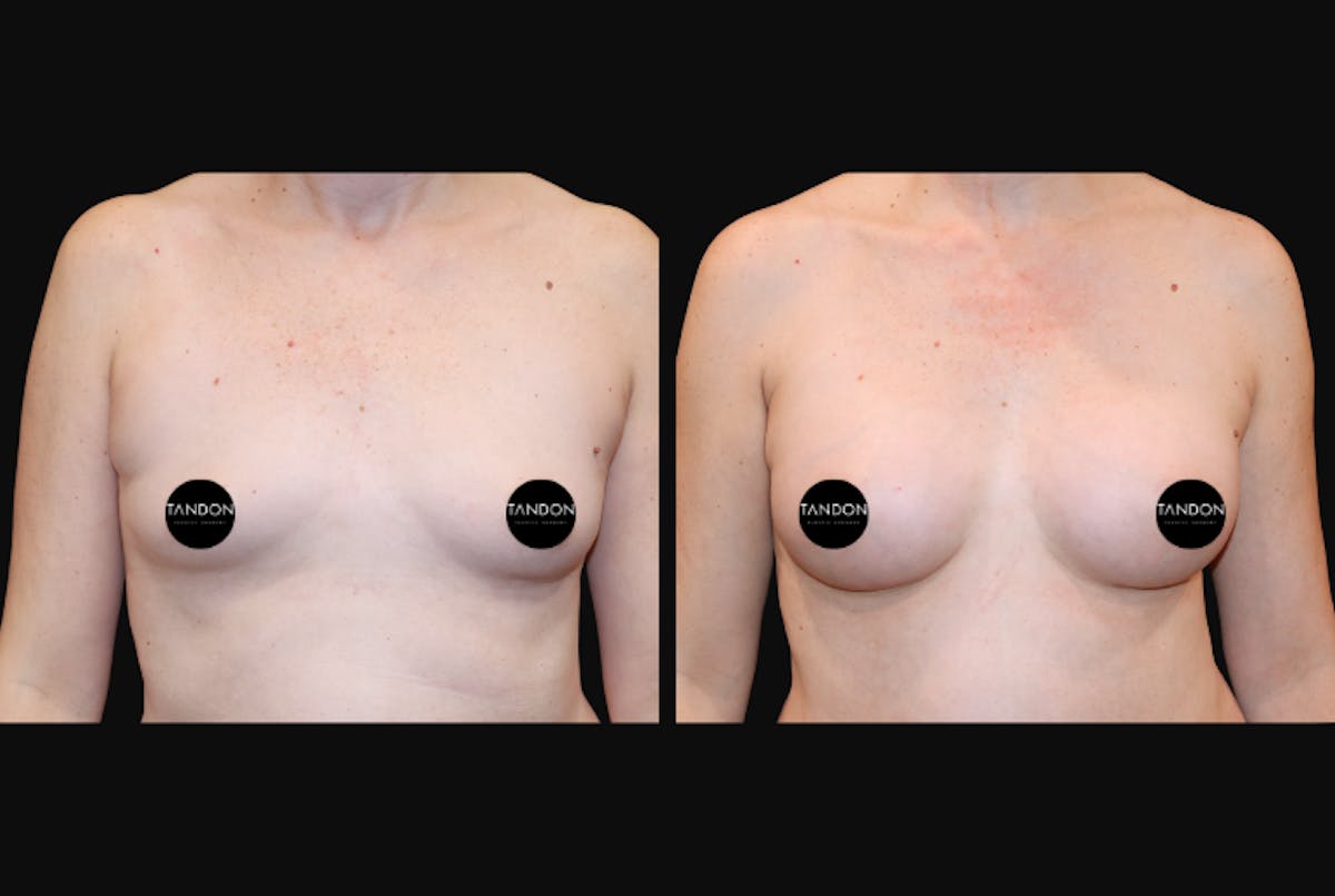 Breast Augmentation Before & After Gallery - Patient 401136 - Image 1
