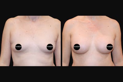Breast Augmentation Before & After Gallery - Patient 401136 - Image 1