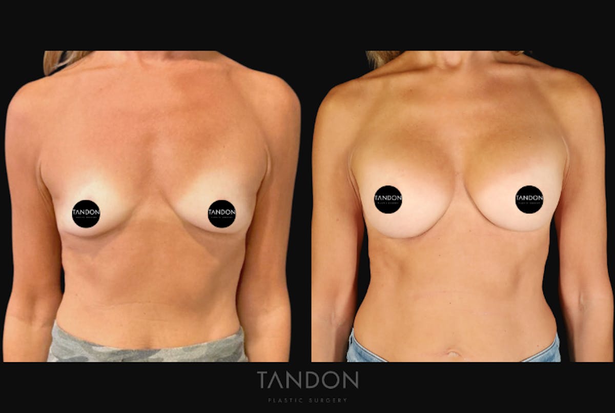 Breast Augmentation  Before & After Gallery - Patient 246175 - Image 1