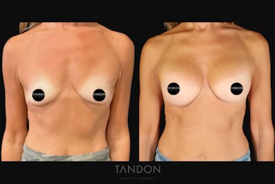 Breast Augmentation Before & After Gallery - Patient 246175 - Image 1