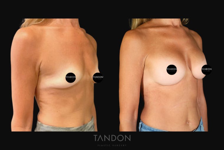 Breast Augmentation Before & After Gallery - Patient 246175 - Image 2