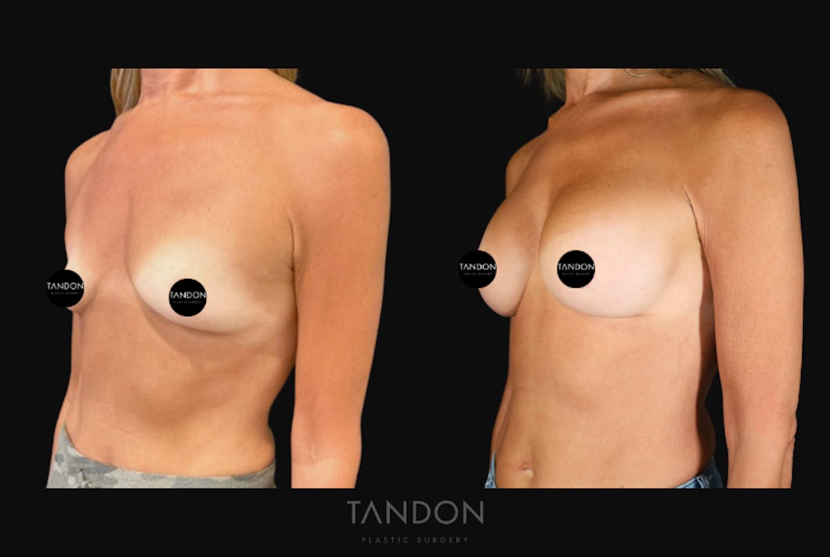 Breast Augmentation  Before & After Gallery - Patient 246175 - Image 5