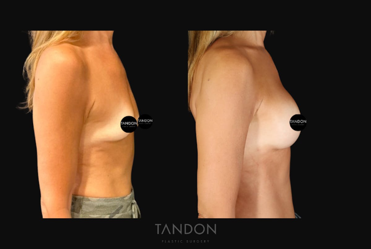 Breast Augmentation  Before & After Gallery - Patient 246175 - Image 3
