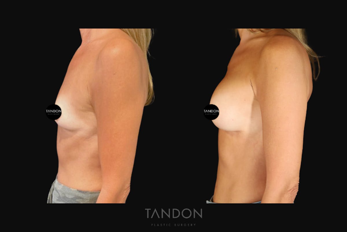 Breast Augmentation  Before & After Gallery - Patient 246175 - Image 4