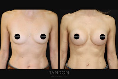 Breast Augmentation Before & After Gallery - Patient 283672 - Image 1