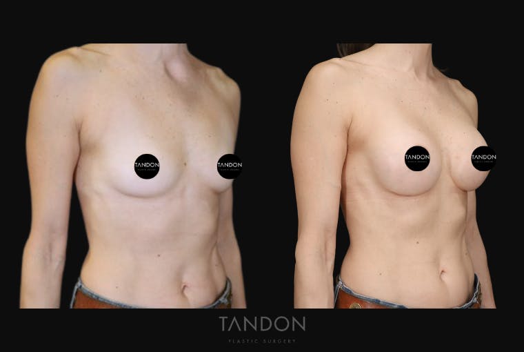 Breast Augmentation Before & After Gallery - Patient 283672 - Image 2