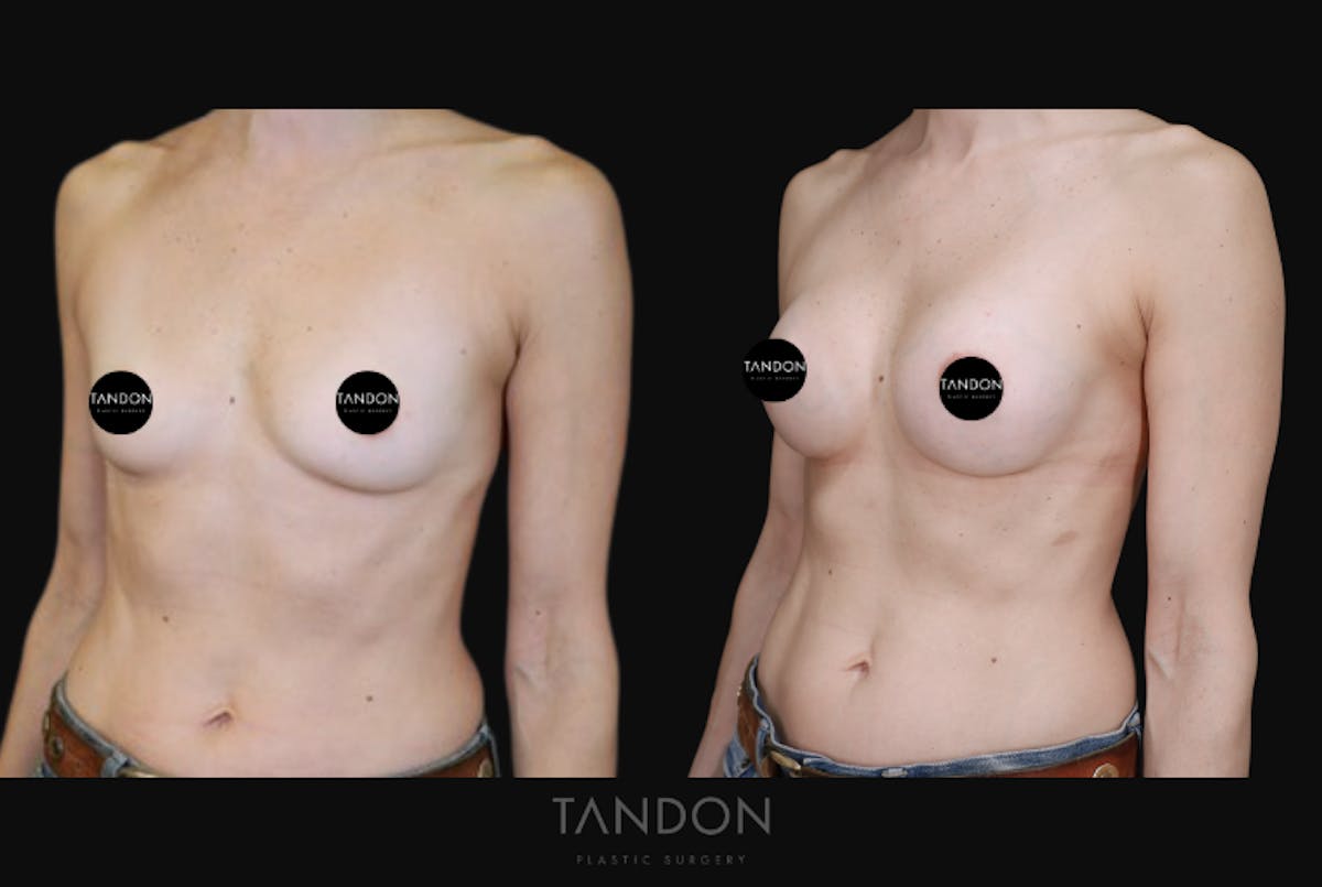 Breast Augmentation  Before & After Gallery - Patient 283672 - Image 5