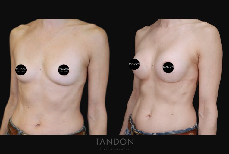 Breast Augmentation Before & After Gallery - Patient 283672 - Image 5