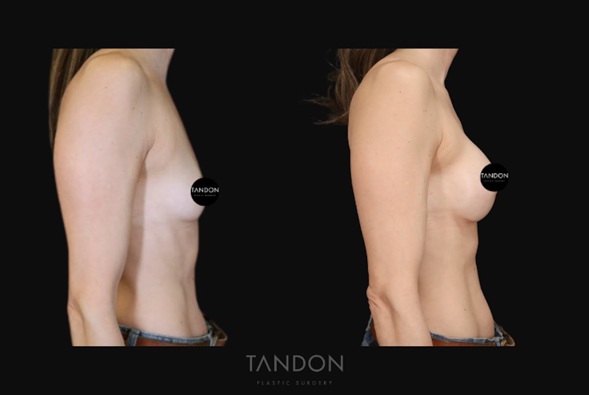 Breast Augmentation  Before & After Gallery - Patient 283672 - Image 3
