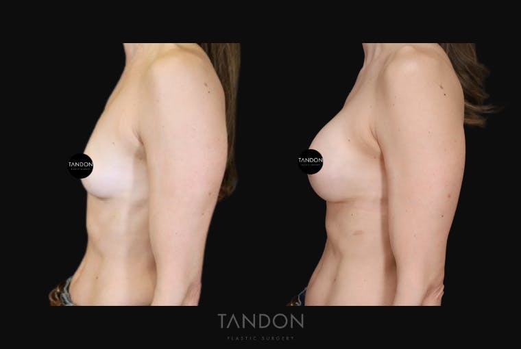 Breast Augmentation Before & After Gallery - Patient 283672 - Image 4
