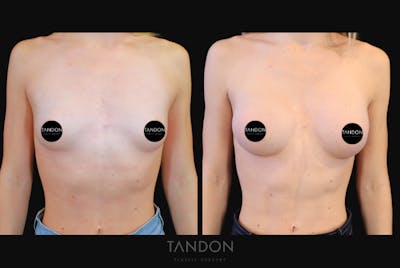 Breast Augmentation Before & After Gallery - Patient 871009 - Image 1