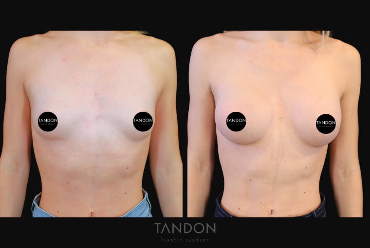 Breast Augmentation Before & After Gallery - Patient 871009 - Image 1