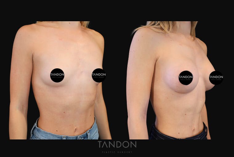Breast Augmentation Before & After Gallery - Patient 871009 - Image 2