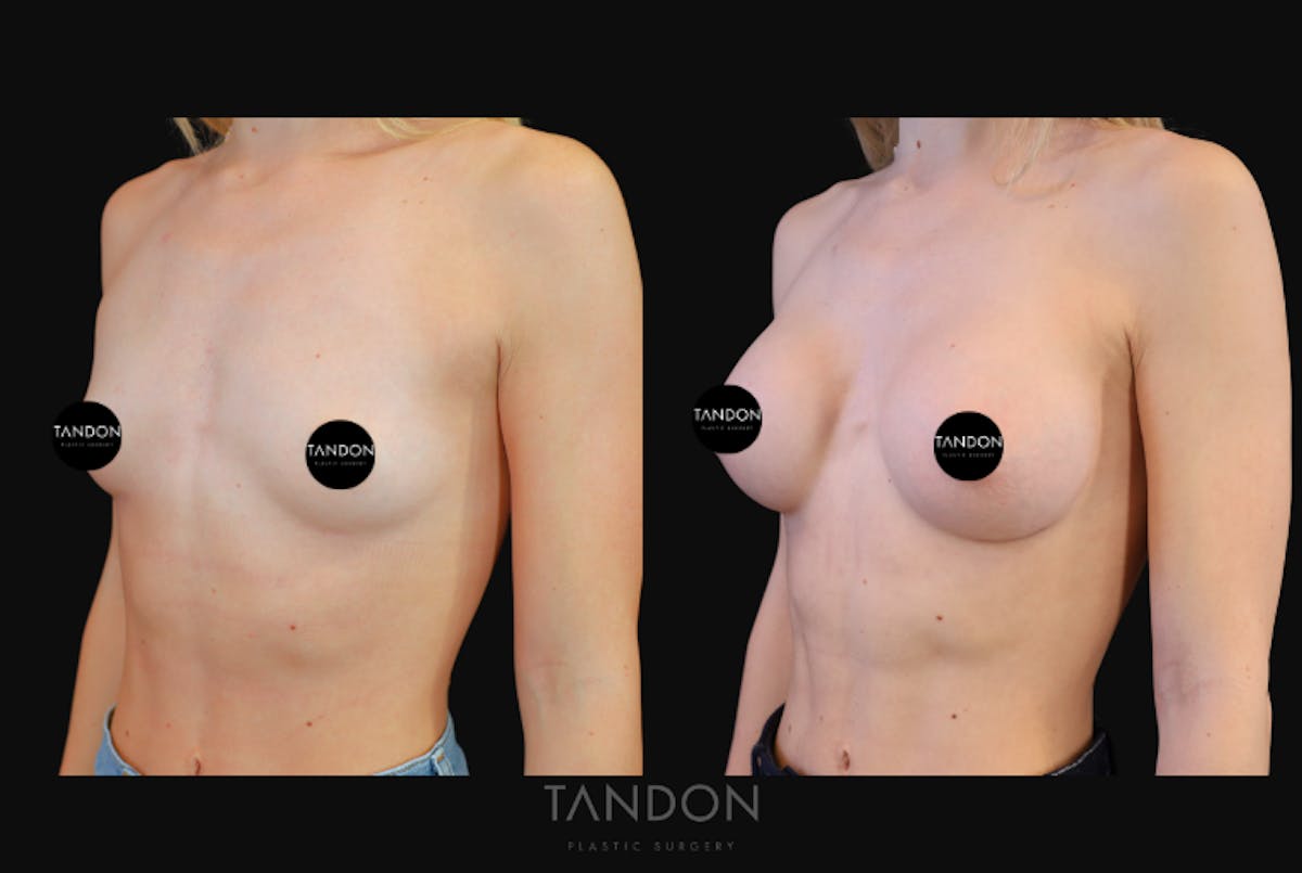 Breast Augmentation  Before & After Gallery - Patient 871009 - Image 5