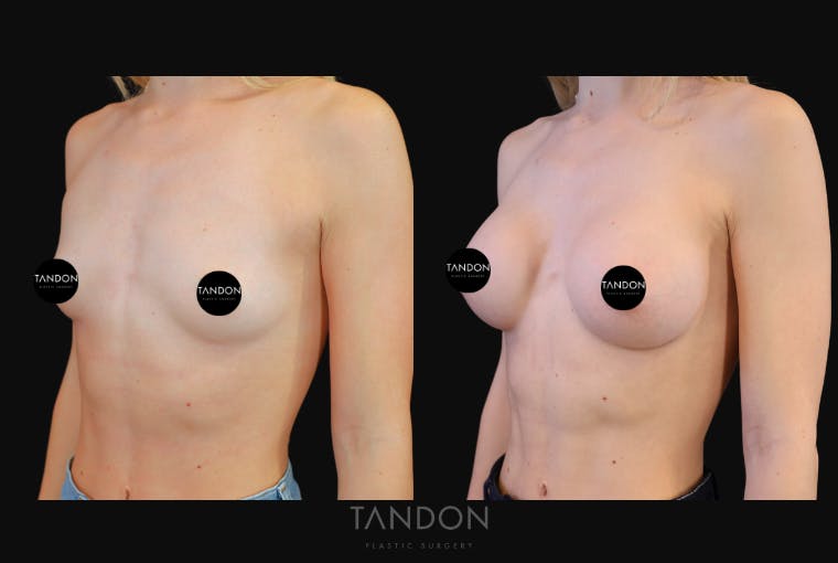 Breast Augmentation Before & After Gallery - Patient 871009 - Image 5