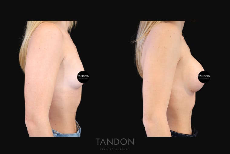 Breast Augmentation Before & After Gallery - Patient 871009 - Image 3