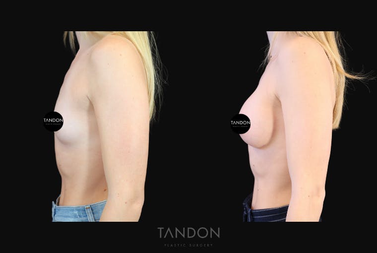 Breast Augmentation Before & After Gallery - Patient 871009 - Image 4