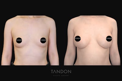 Breast Augmentation Before & After Gallery - Patient 928334 - Image 1