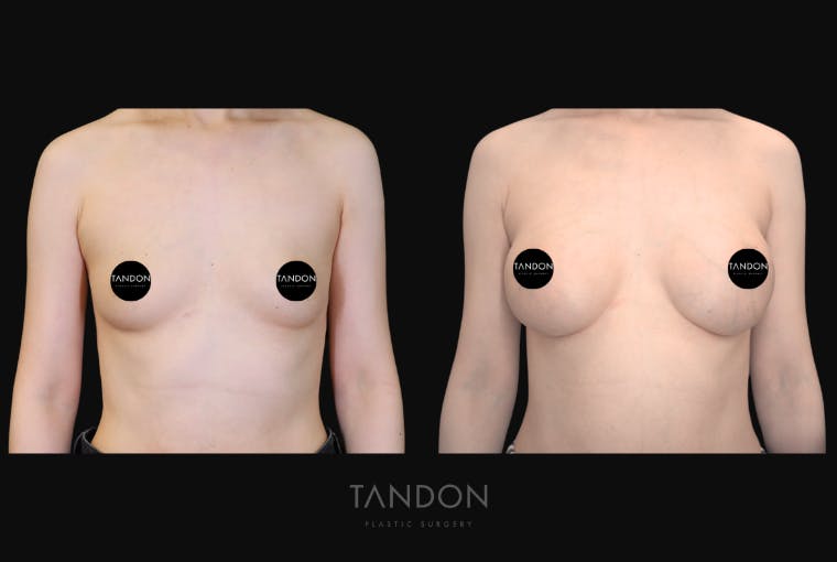Breast Augmentation Before & After Gallery - Patient 928334 - Image 1