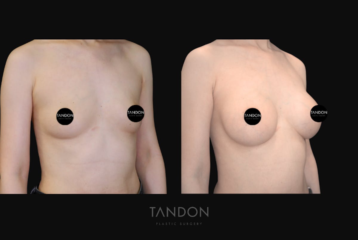 Breast Augmentation Before & After Gallery - Patient 928334 - Image 2