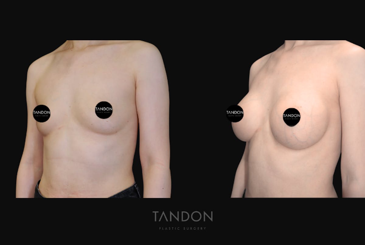 Breast Augmentation Before & After Gallery - Patient 928334 - Image 5