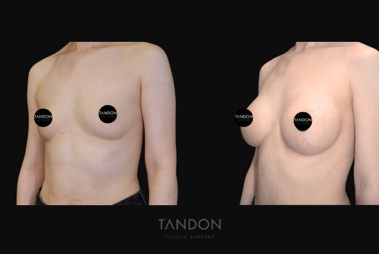 Breast Augmentation Before & After Gallery - Patient 928334 - Image 5