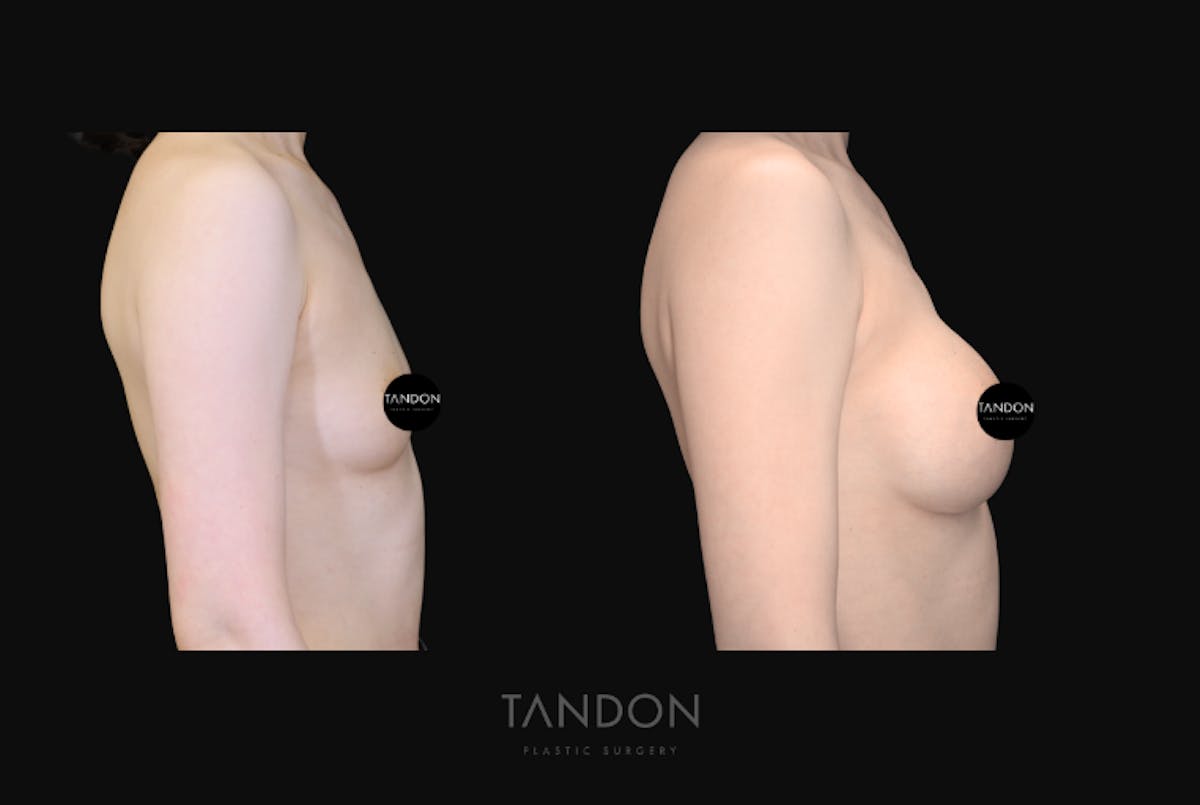 Breast Augmentation Before & After Gallery - Patient 928334 - Image 3