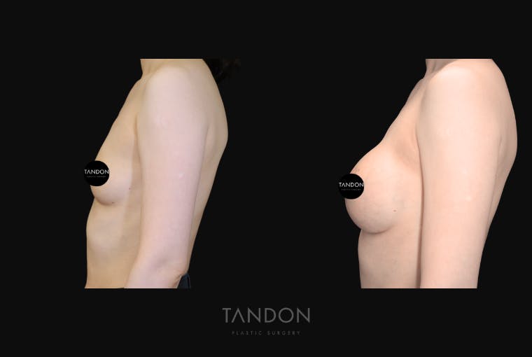 Breast Augmentation Before & After Gallery - Patient 928334 - Image 4