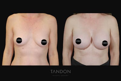 Breast Augmentation Before & After Gallery - Patient 428524 - Image 1