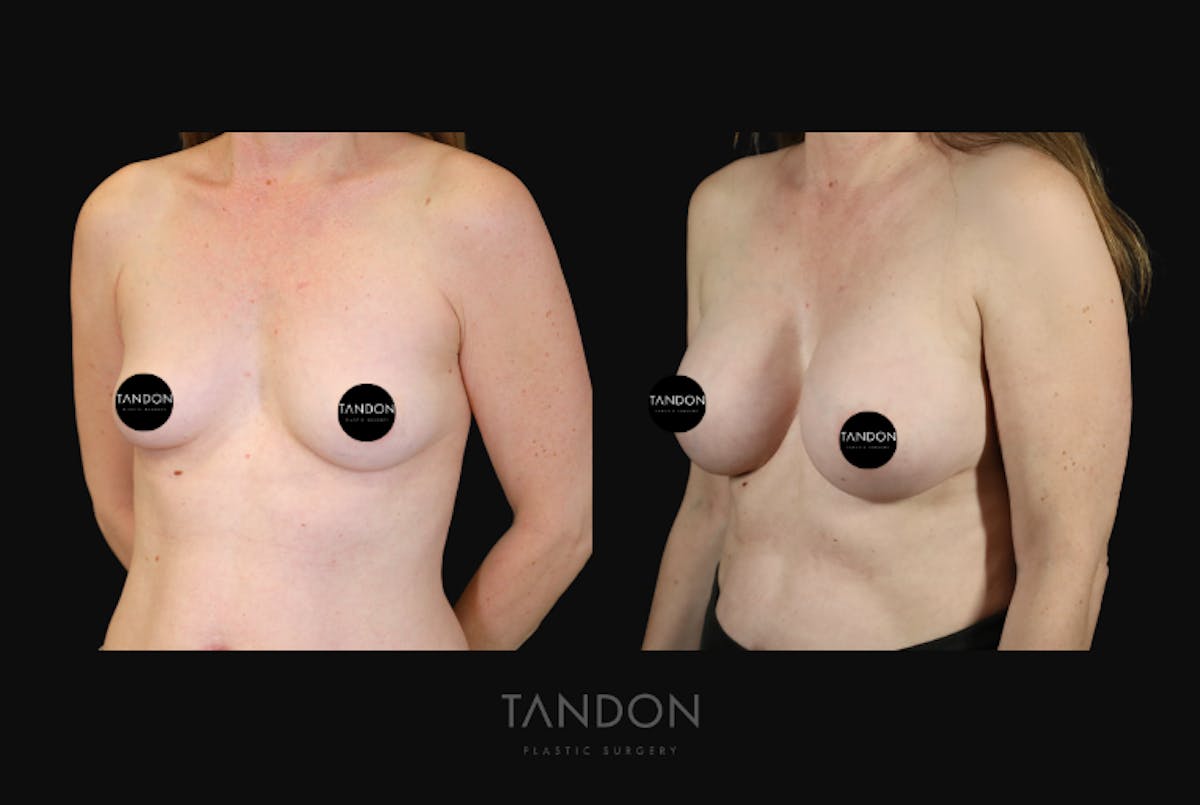 Breast Augmentation Before & After Gallery - Patient 428524 - Image 5