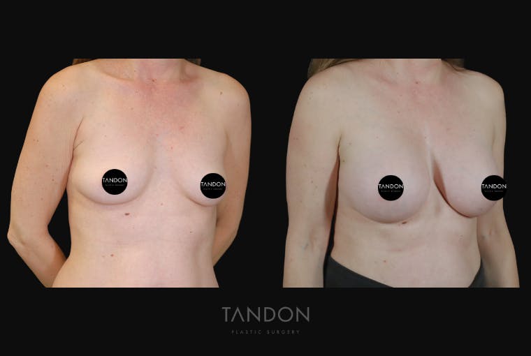 Breast Augmentation Before & After Gallery - Patient 428524 - Image 2
