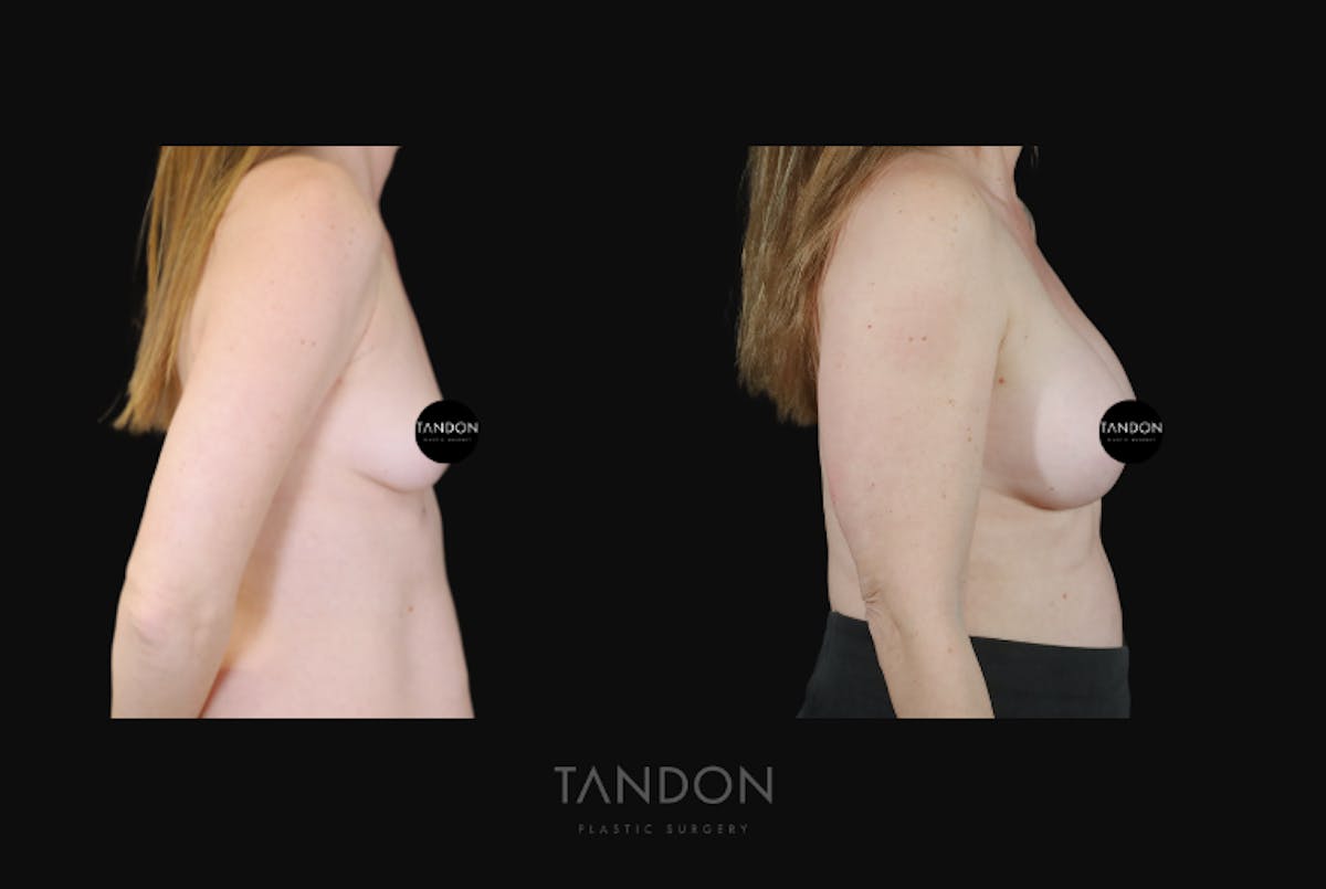 Breast Augmentation Before & After Gallery - Patient 428524 - Image 3