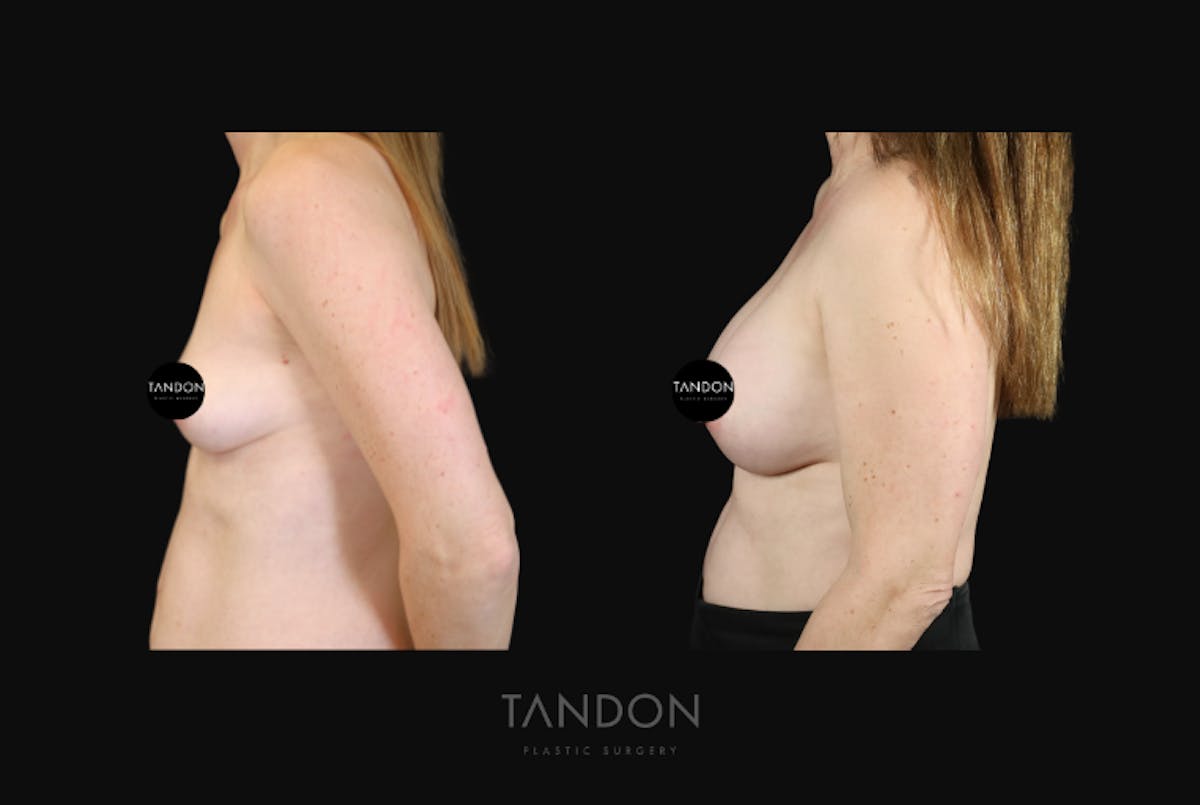 Breast Augmentation Before & After Gallery - Patient 428524 - Image 4
