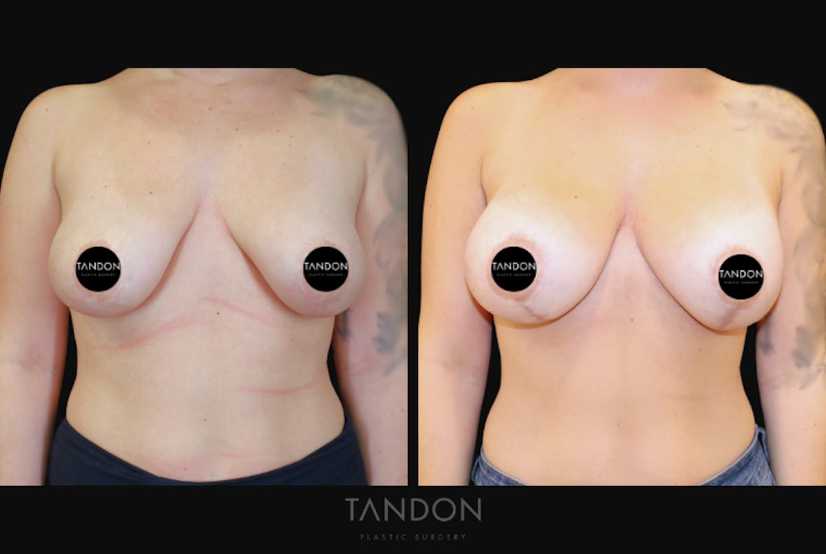 Breast Revision Before & After Gallery - Patient 277235 - Image 1