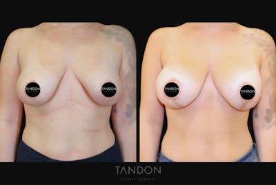 Breast Revision Before & After Gallery - Patient 277235 - Image 1