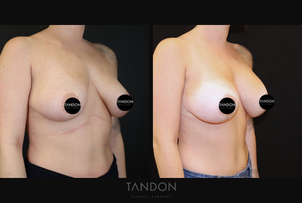 Breast Revision Before & After Gallery - Patient 277235 - Image 2