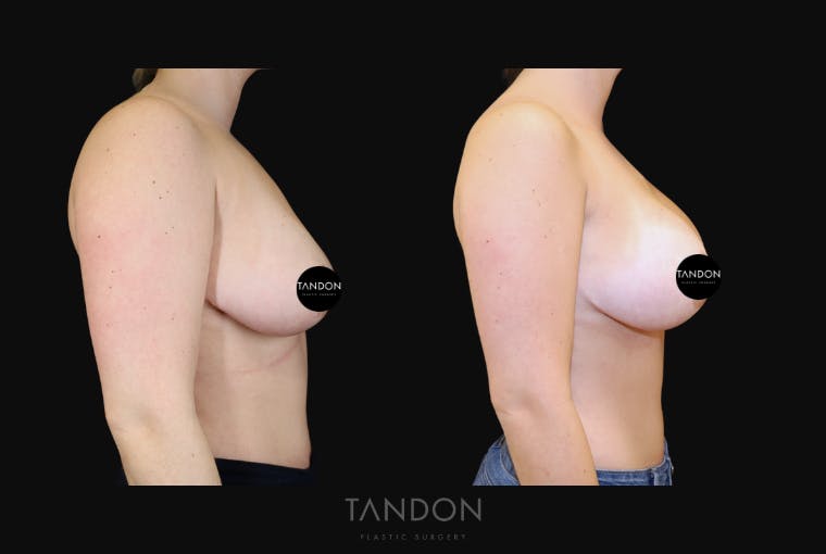 Breast Revision Before & After Gallery - Patient 277235 - Image 3